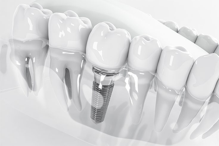 Rrejuvie-Dental-Implant-1
