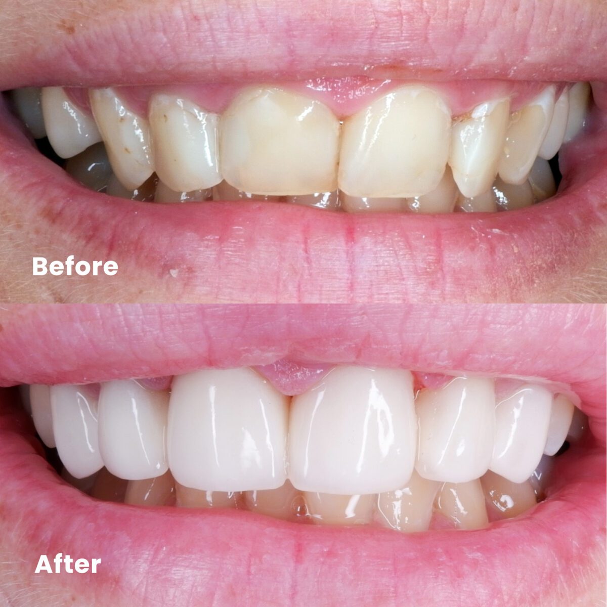 Crown & Veneer - Rejuvie Dental Bali