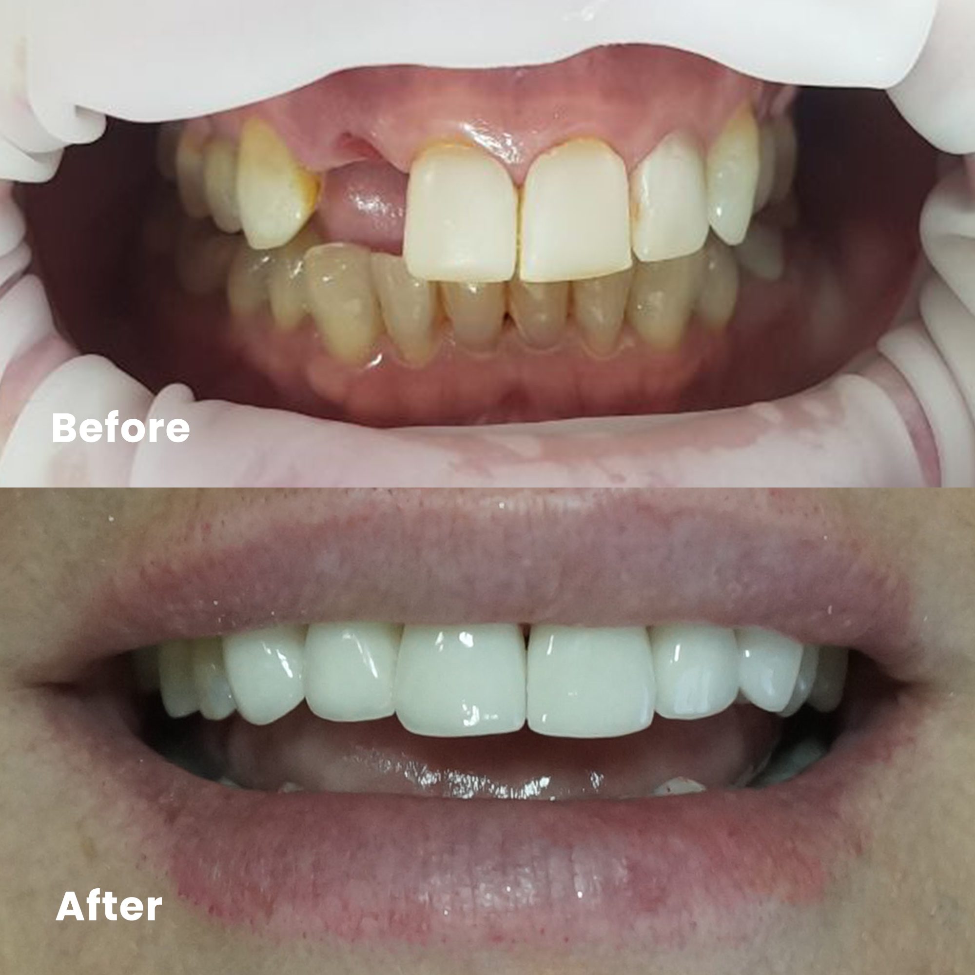 Dental Implant - Rejuvie Dental Bali