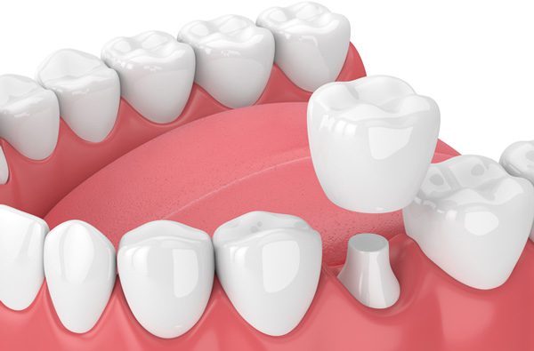 dental crown rejuvie dental bali